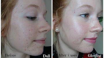 Personal Microderm Review! PMD Demo and Before & After Pictures!