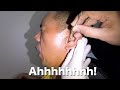 Man's Massive Earwax Removal