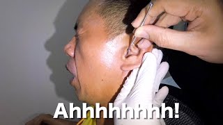 Man's Massive Earwax Removal