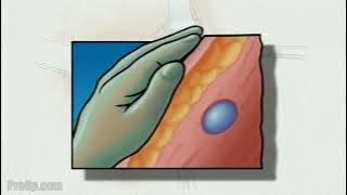 PreOp® General Biopsy Surgery