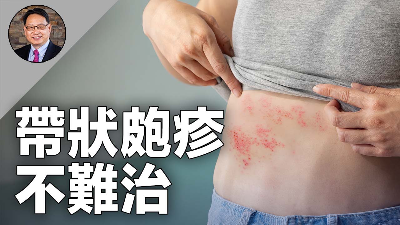終結帶狀皰疹的最佳方案!早期徵兆及後遺症治療全揭秘。 - YouTube