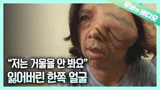 A Man Suffering From Neurofibroma, His Melted Left Face