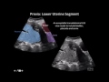 Ultrasound Diagnosis of Placenta Accreta A Tutorial for Imagers