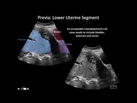 Ultrasound Diagnosis of Placenta Accreta A Tutorial for Imagers