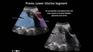 Ultrasound Diagnosis of Placenta Accreta A Tutorial for Imagers