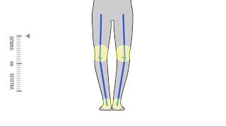 iWalk 2.0 Fitting - Identifing Your Leg Type