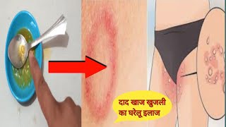 दाद खाज खुजली की 1 दिन में छुट्टी कर सकती है |  सिर्फ यह 2 चीजें | Fungal Ringworm | Daad Ka ilaj |