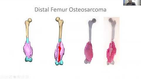 3D Bio-modeling, Virtual Surgical Planning and Printing in Pediatric Oncology and Neurosurgery