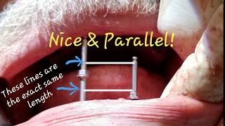 Making Dentures Great Again