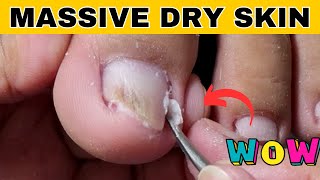 Ingrown Toenail Removal Pedicure