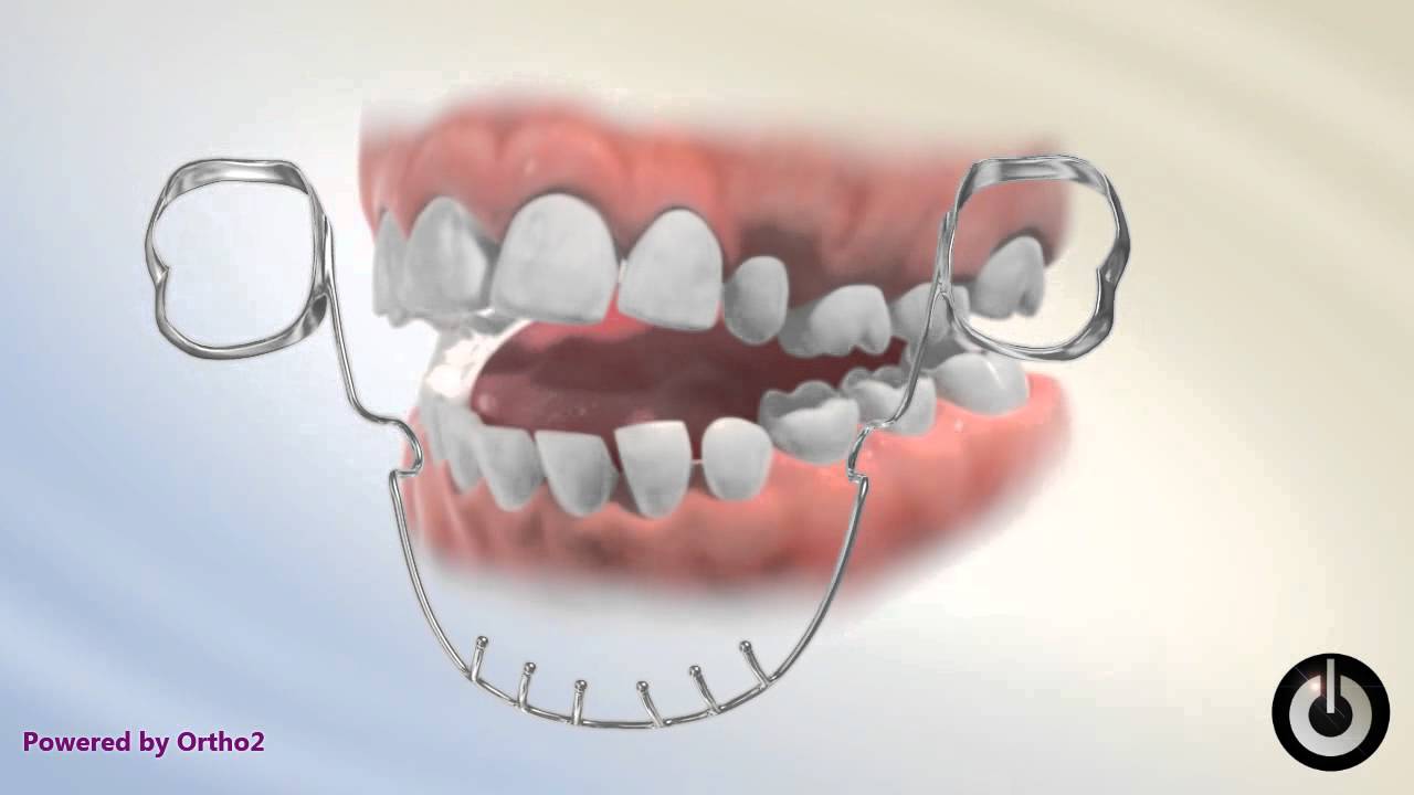 Lower Tongue Crib YouTube