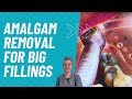 Removing Large Amalgam Fillings [Holistic Dentist Brisbane]