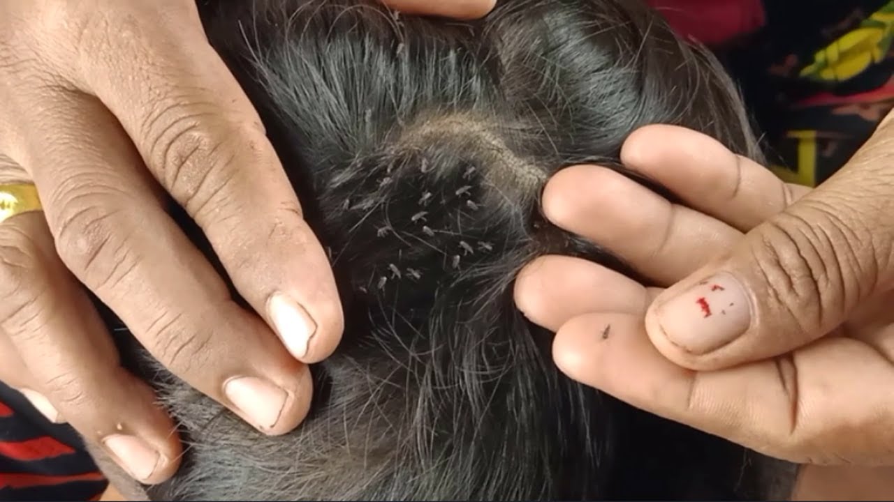 大きなシラミ駆除ショートヘア 自宅で千シラミを駆除する方法 03 Youtube 大きなシラミ駆除ショートヘア 自宅で千シラミを駆除する方法 03 Youtube