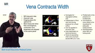 Vena Contracta for Mitral Regurgitation - How I do it series