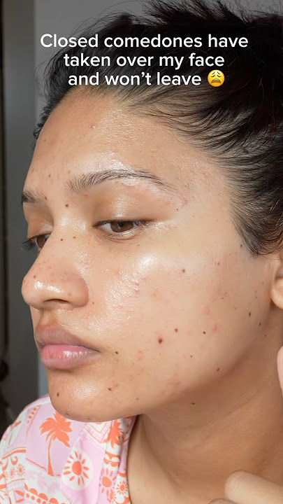 Download lagu Closed comedones have ly taken over my face 😩 But what exactly are they?