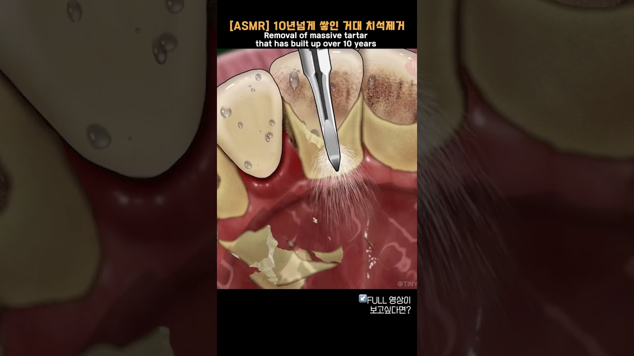 [ASMR] 10년넘게 쌓인 거대 치석제거 / Removal of massive tartar that has built up over 10 years