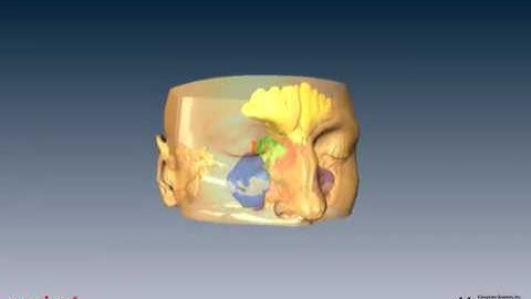 Amira | 3D visualization and analysis | 3D visualization of Paranasal Study