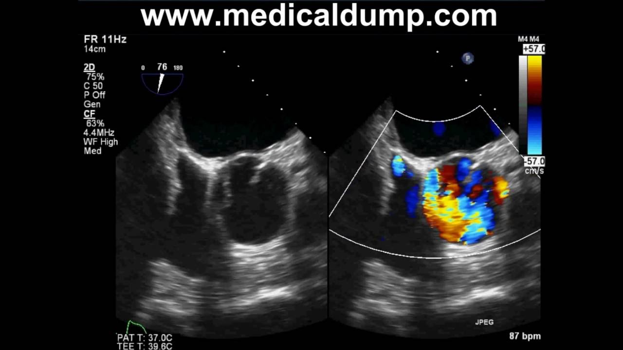 Bicuspid Aortic Valve Severe Aortic Regurgitation