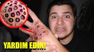Elinizde BÖYLE DELİKLER Görürseniz HEMEN Hastaneye Koşun! (İÇİNDE BİR ŞEYLER VAR..)