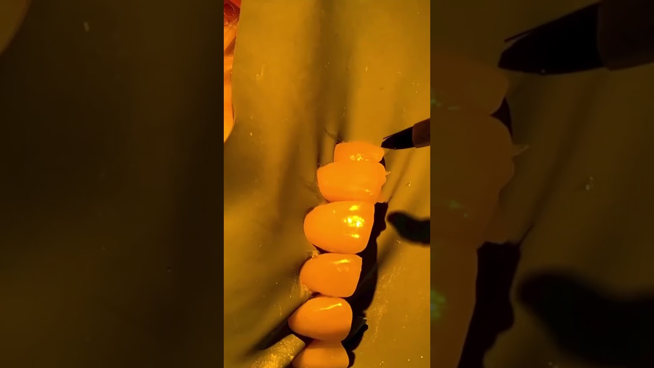 ✨ Ultra Thin Partial Veneers Part II ✨