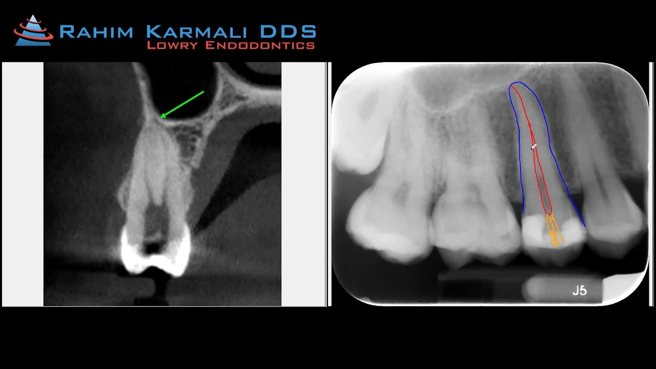 What Is An Endodontists and What Do They Do? YouTube