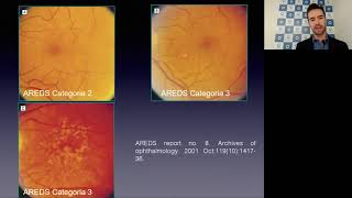 Aula de Retina: Fisiopatologia, diagnóstico e classificação da DMRI