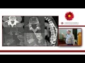 Kyphoplasty (Vertebral Augmentation) for Myeloma: The Cement Facts - Is It Worth It?