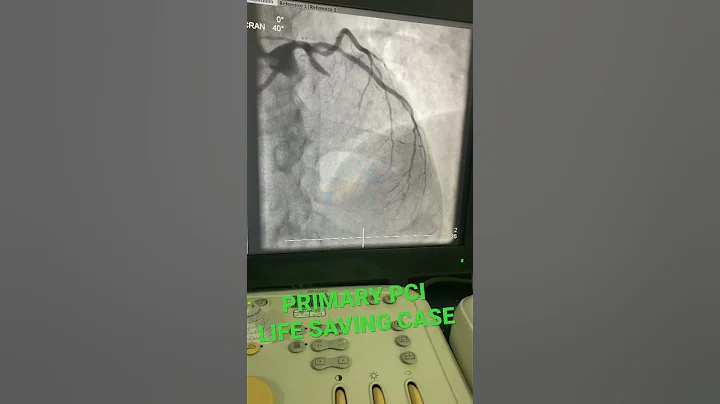Occluded LAD | Primary PCI to LAD | Coronary Angiogram