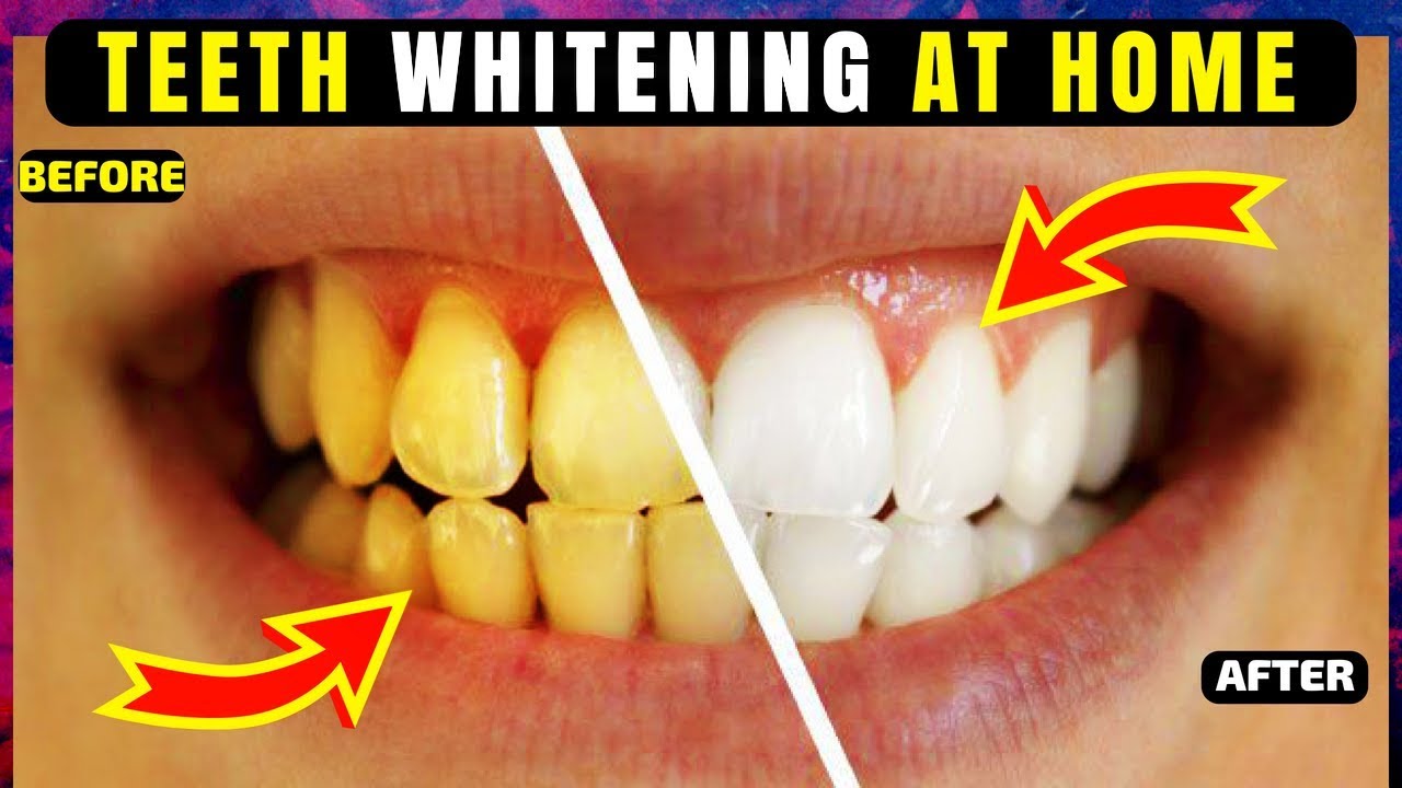 Teeth Whitening At Home In 5 Minutes How To Whiten Your Yellow Teeth