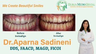 Actual Patient Of Dr. Sadineni Sharing His Experience With Invisalign