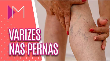 Qual o melhor remédio para varizes nas pernas?