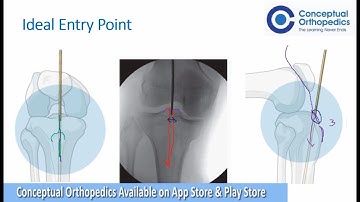 Tibia Nailing by Exemplary Trauma Surgeon Dr.Shailesh Pai - Conceptual Orthopedics