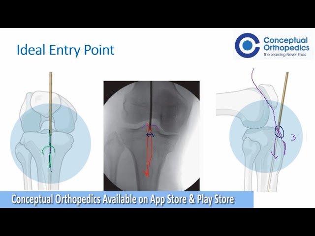 Minimally Invasive Approach for Tibial Nailing