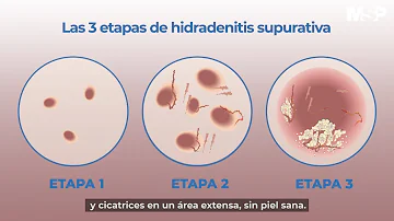 ¿Cuál es el tratamiento de primera línea de la hidradenitis supurativa?