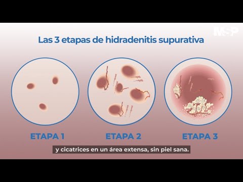 Vídeo: Consejos Para Manejar Su Salud Mental Con Hidradenitis Supurativa