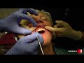 Реальная стоматология! Фиксация временных виниров в клинике "Стоматология БЕСТ"