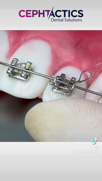 Crimpable Hook in Orthodontics 