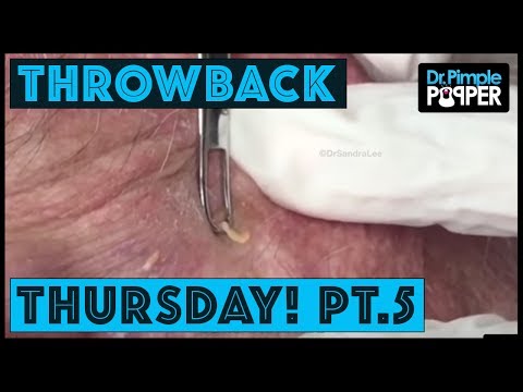 Reminiscing With Dr Pimple Popper: Part 5, TBT