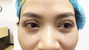 Cắt Mí Sụp Bằng Công Nghệ Mani Open Deep 5D