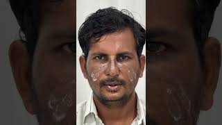 Rhinoplasty -Splint Removal