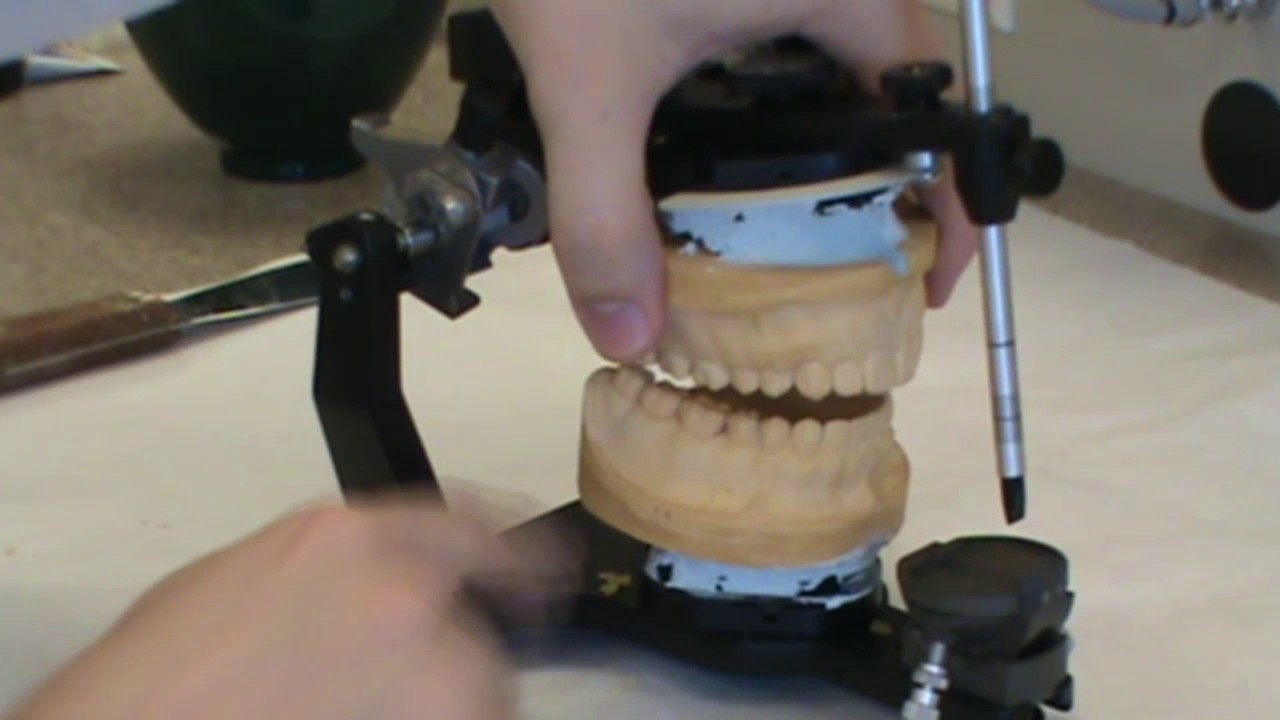 12 How to make and mount Diagnostic Casts Mounting Mandibular Cast on