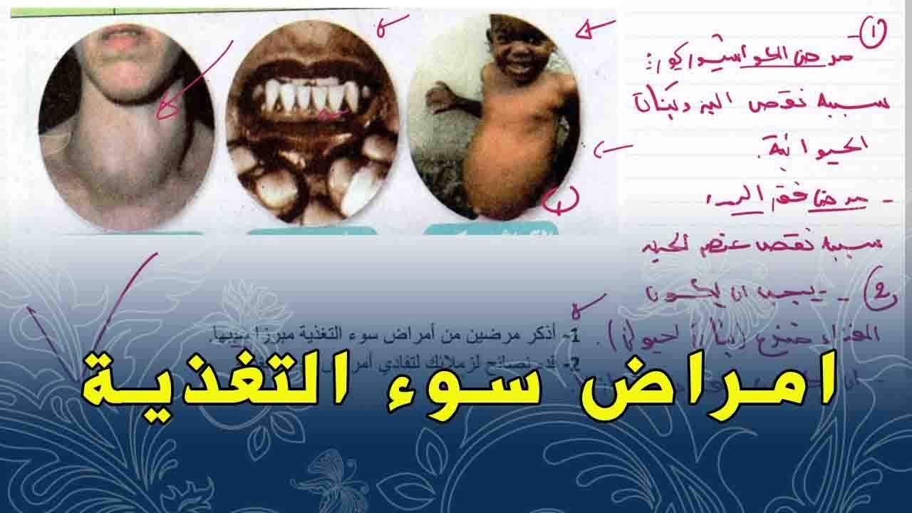 علوم طبيعية اولى متوسط وضعية ادماجية على امراض سوء التغذية