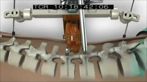 Mazor Robotics segment from Prophets of Science Fiction.wmv