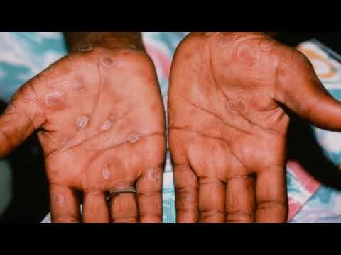 Video: Rozdíl Mezi Syfilis A Herpes