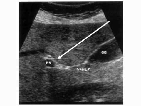 What are some reasons for a liver ultrasound?