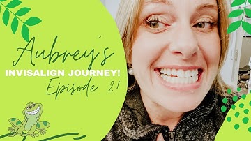 How Does the iTero Scanner Work? | Aubrey