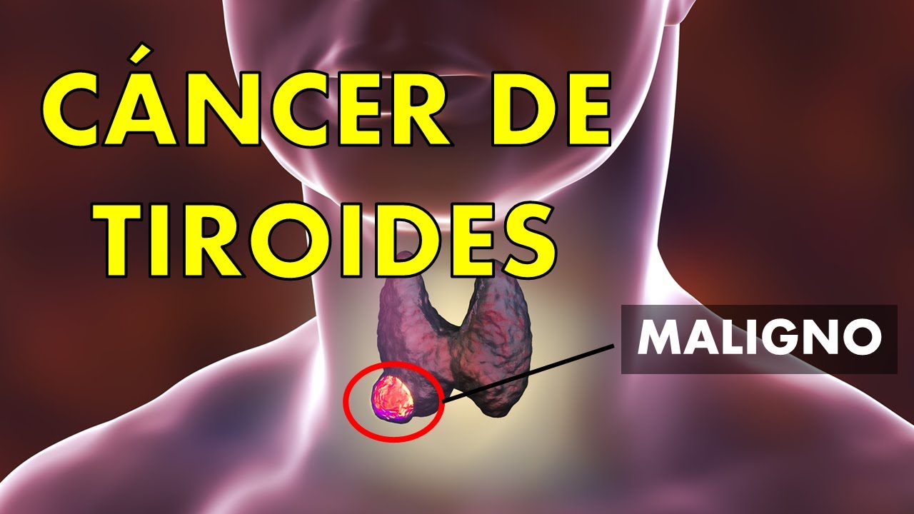 Cáncer de tiroides: señales de alerta y tratamiento clave