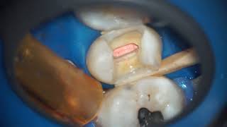 COMPLETE ENDODONTIC TREATMENT + DENTAL ASSISTANT video CLINCAL STEP BY STEP