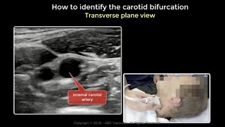 CAROTID ULTRASOUND  THE CAROTID BIFURCATION