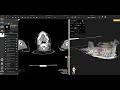 AI Dental Segmentation in DICOM Vision: TotalSegmentator + ToothFairy Demo #1
